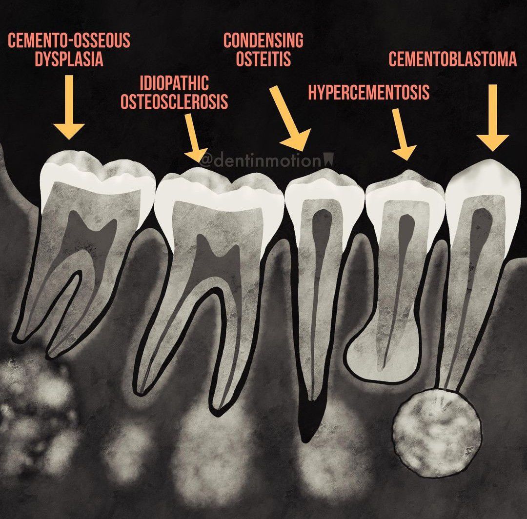 Periapical Radioopacities - MEDizzy