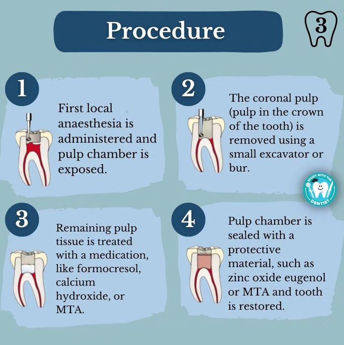 Pulpotomy - Procedure