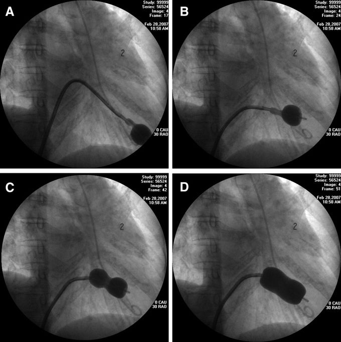 Criteria of Mitral Valvuloplasty