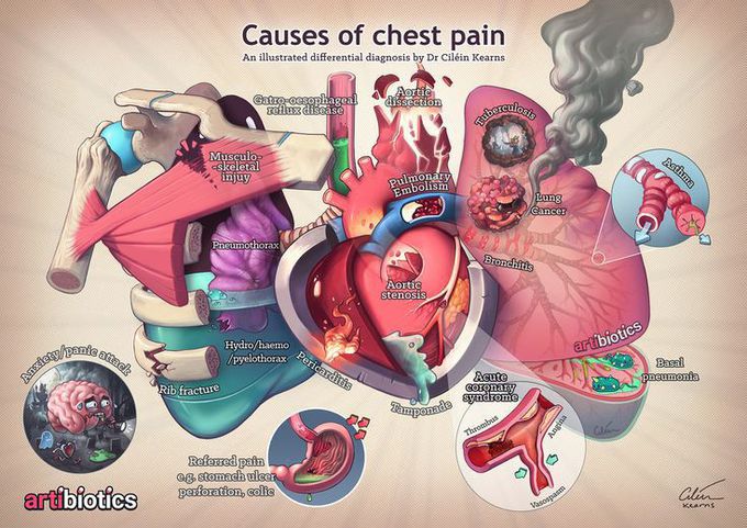 Chest pain causes