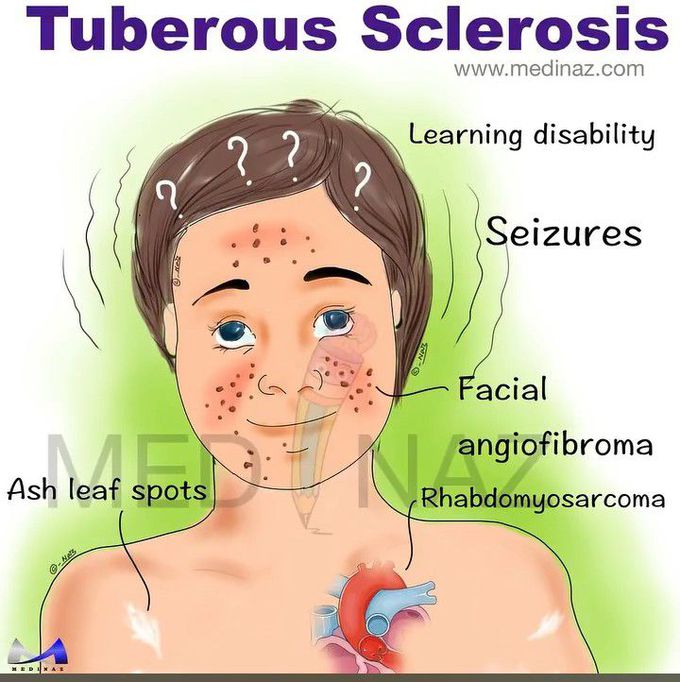 Tuberous sclerosis- Mnemonic