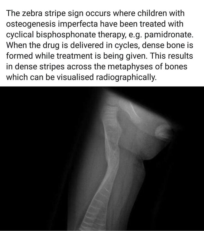 Zebra stripe sign.(Femur)