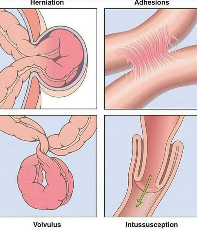 Types of intestinal obstruction