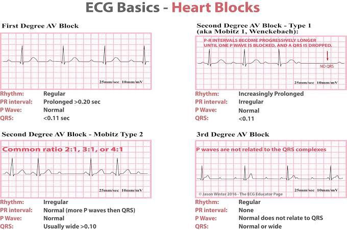 Heart Block