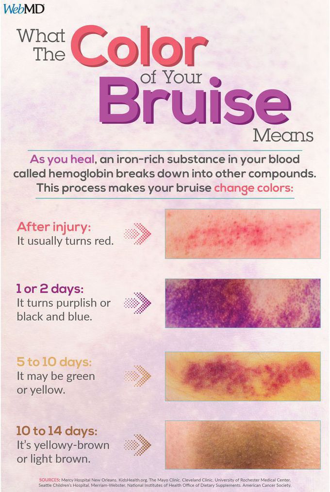 Bruise color indicates