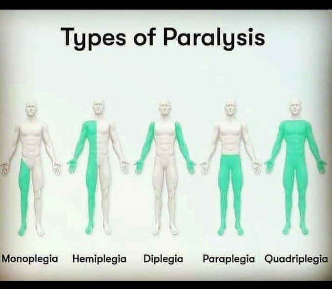 Types of paralysis