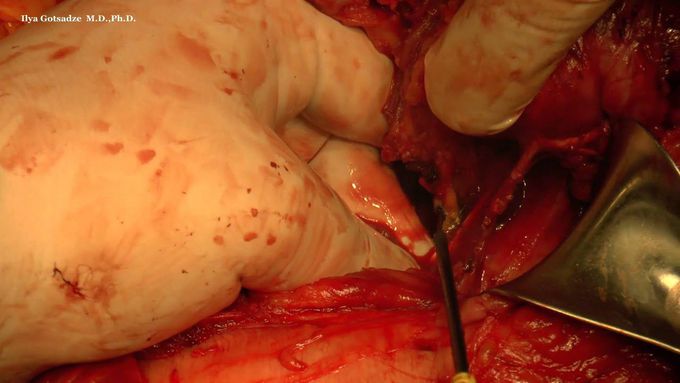 Surgery Giant Abdominal Sarcoma with Right Hemicolectomy