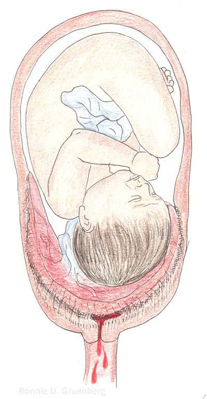 #what type of placenta previa is it ??
