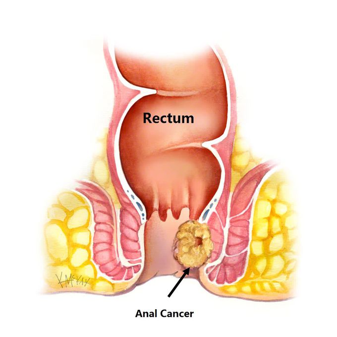 Cause of Anal cancer