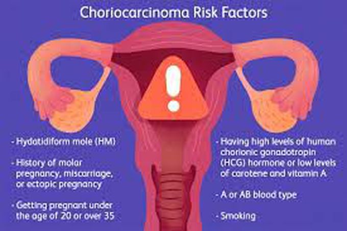 Choriocarcinoma