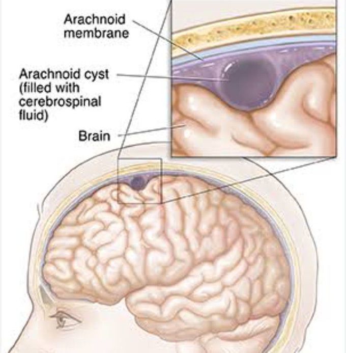 Cause of Arachnoid cysts