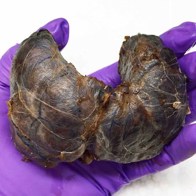 Giant thyroid removed for Graves' disease 🔪