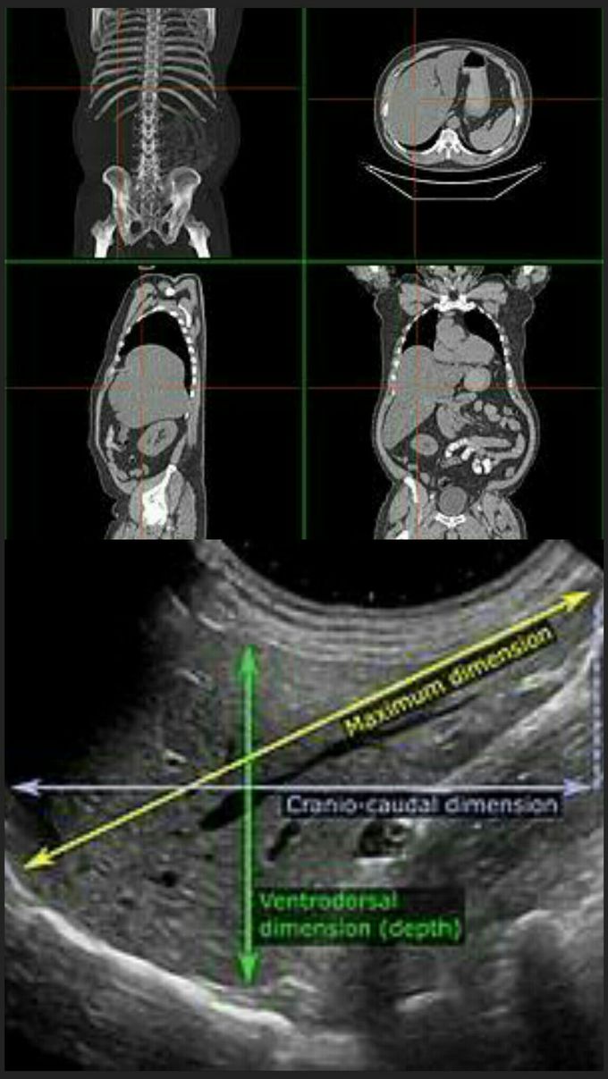 Hepatomegaly