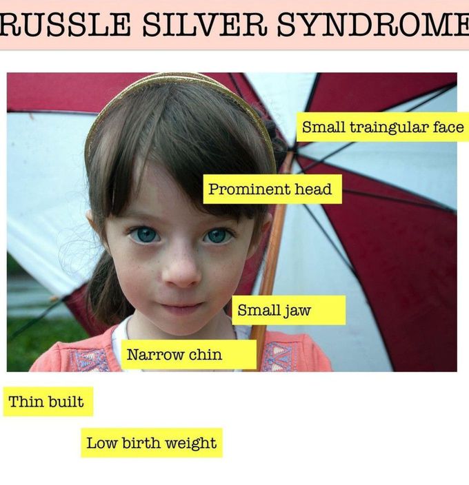 Russle Silver Syndrome