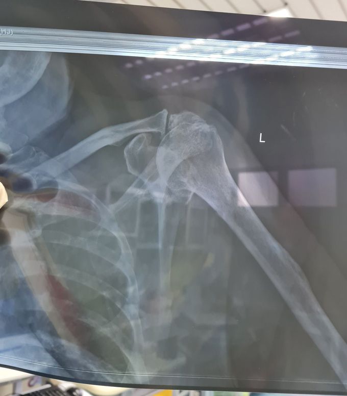 Shoulder xray - need help interpret/analysis.