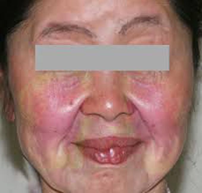 Sarcoidosis