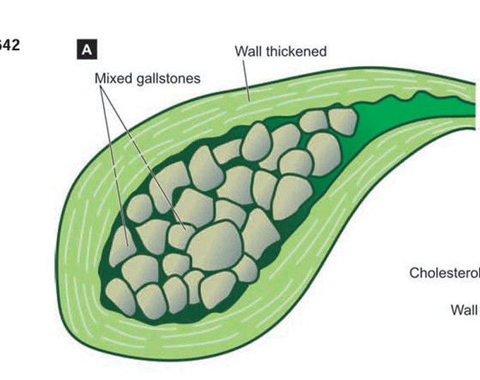 Chronic cholecystitis with cholelithiasis