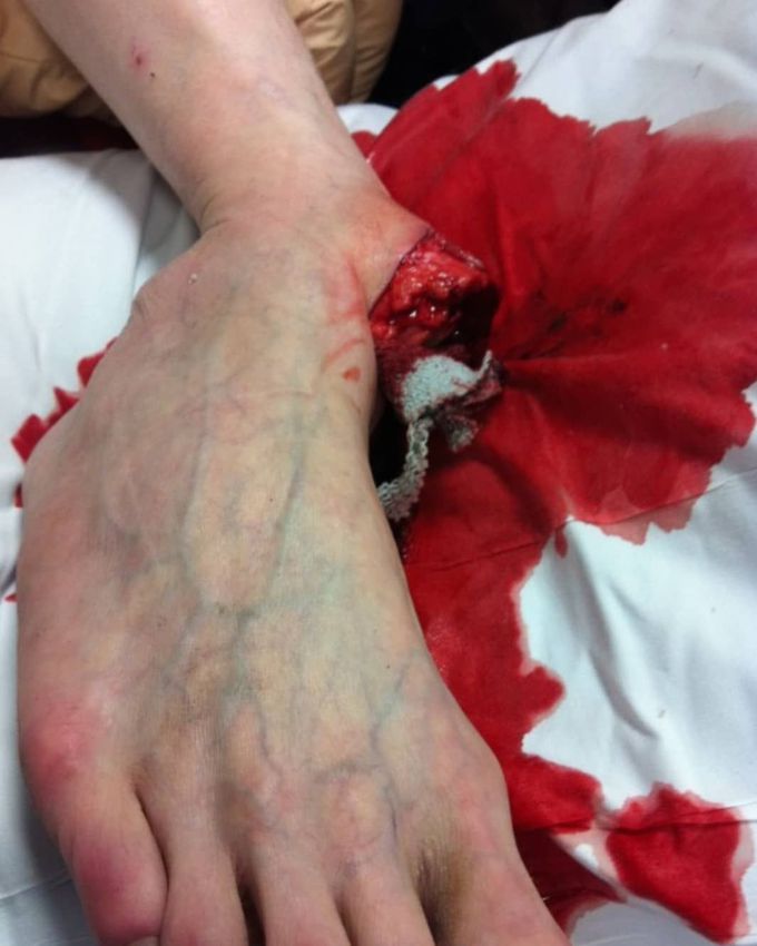 Open ankle fracture/dislocation