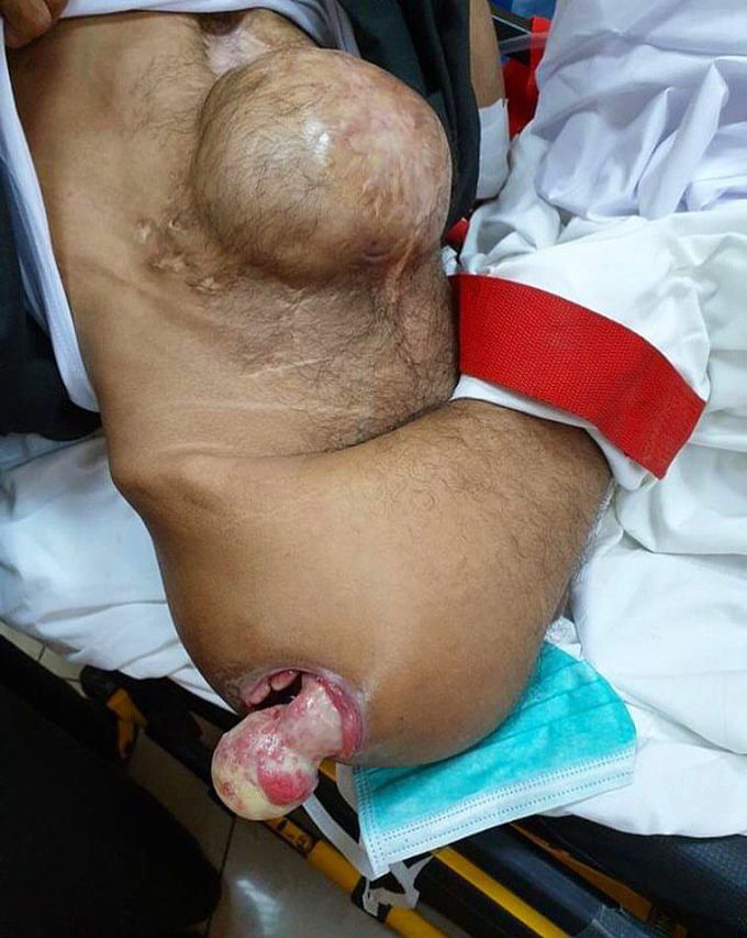 Dislocated infected hip joint in bedridden patient, along with a large incisional hernia!! 
