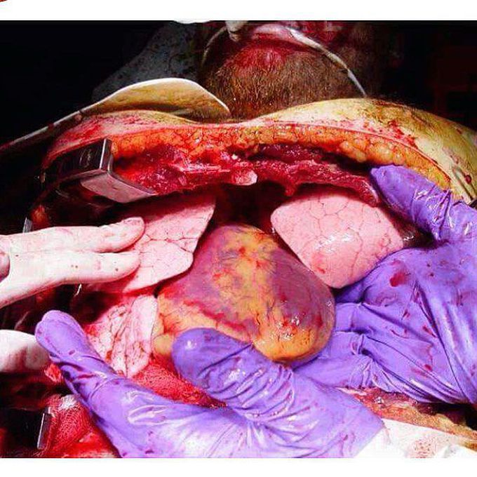 Emergency open thoracotomy