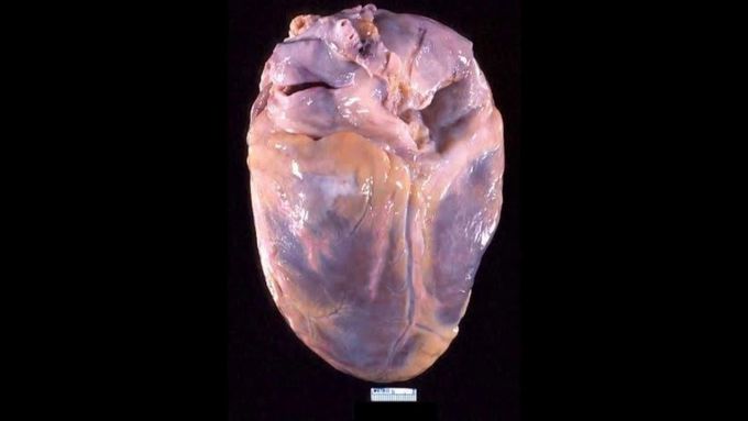Myocardial infarction