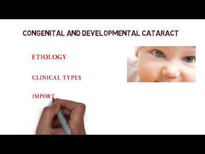 Congenital and developmental cataract