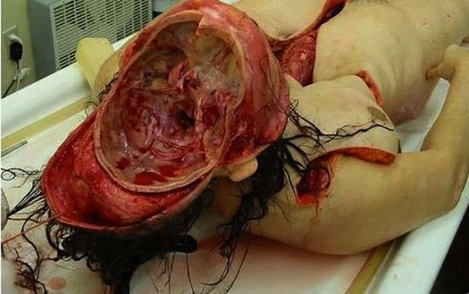 Skull opening and brain removal