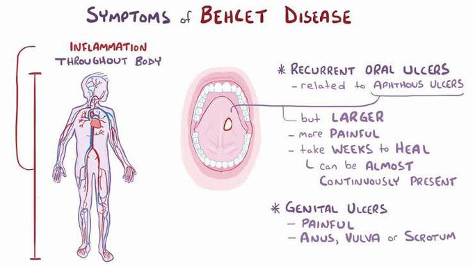 Brhcet disease