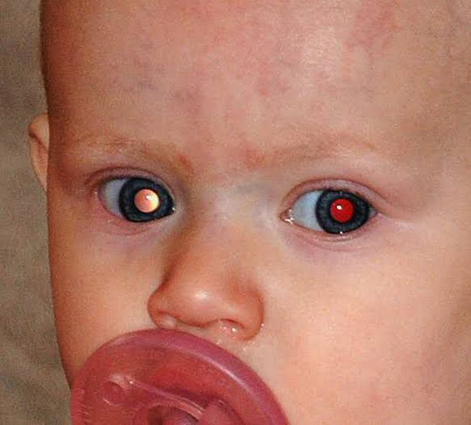 Symptoms of Retinoblastoma