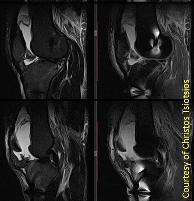 Male patient with metal screws for ACL reconstruction