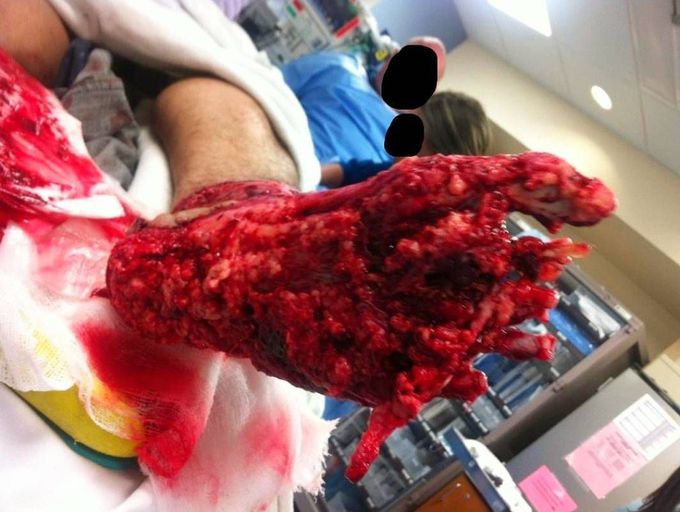 Horrible motorcycle accident with extensive foot trauma.  