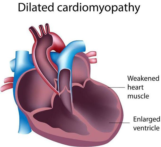 Dilated Cardiomyopathy