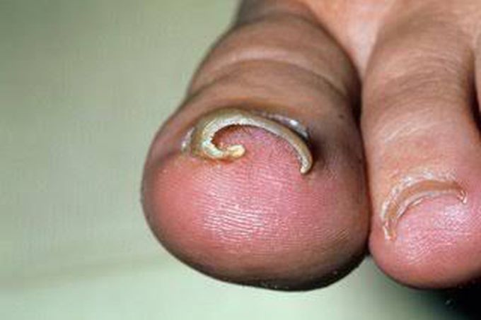 Treatment of ingrown toenail