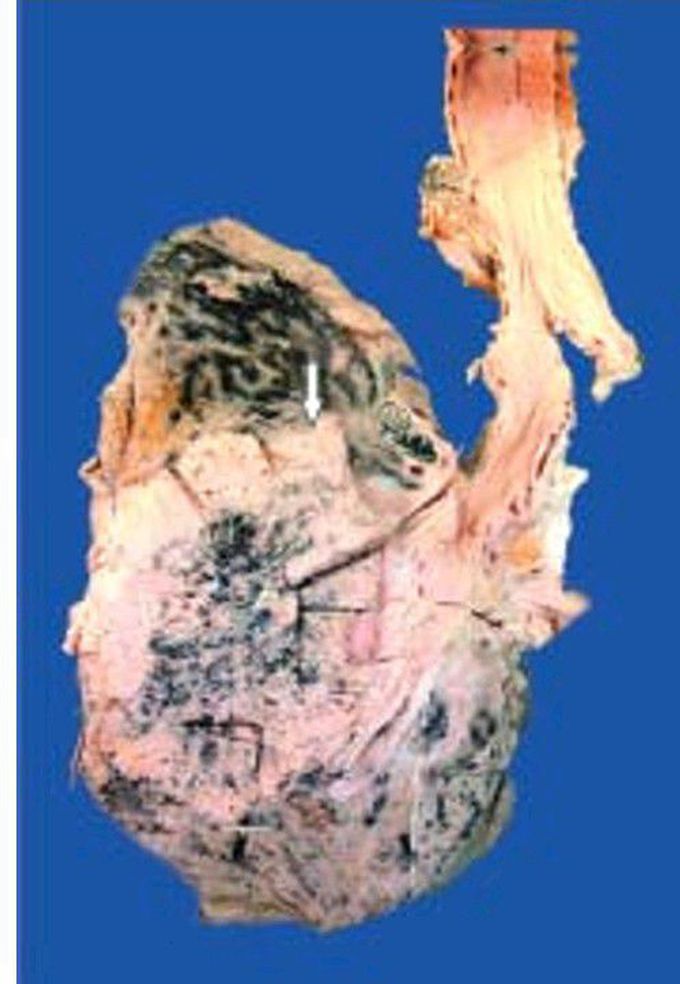 Squamous cell carcinoma lung, hilar type.