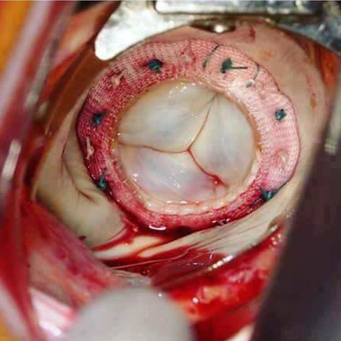 Tricuspid valve