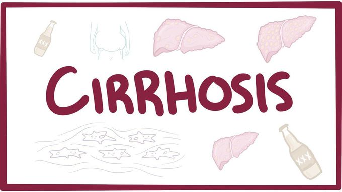Cirrhosis