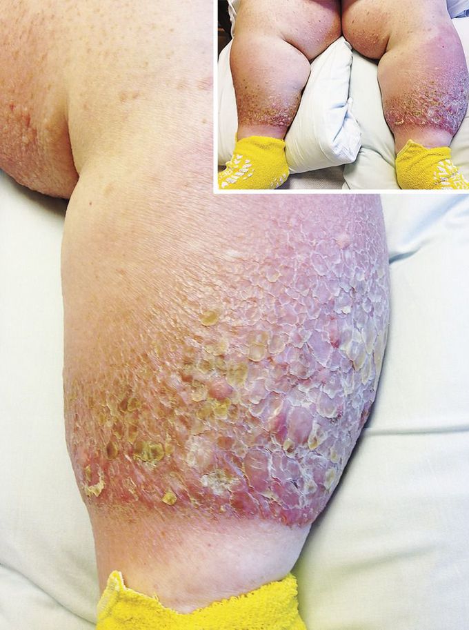 Elephantiasis Nostras Verrucosa