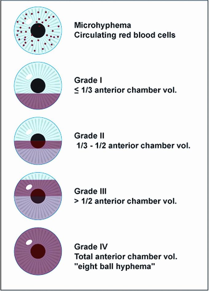 Hyphema