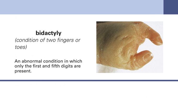 Bidactyly