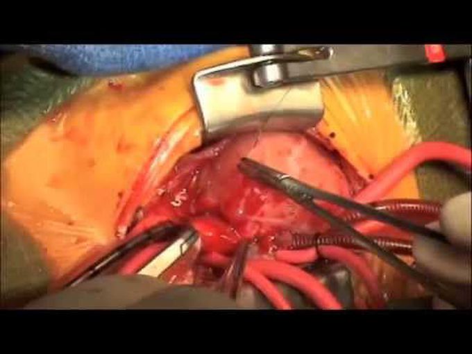 Neonatal Repair of TOF/PA