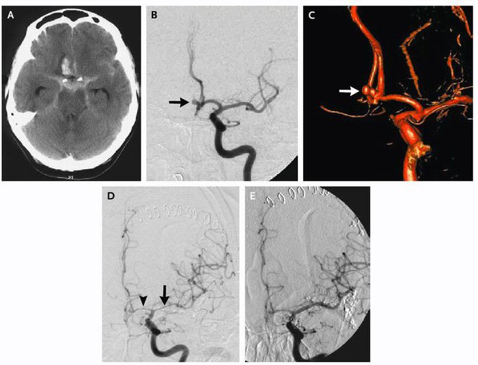 Aneurysmal Subarachnoid Hemorrhage