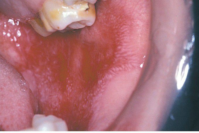 Chronic Cutaneous Lupus Erythematosus (CCLE).