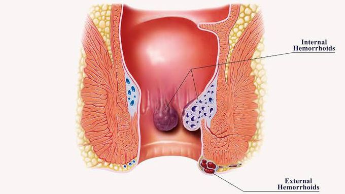 Symptoms of hemorrhoids