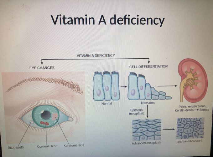 Vitamin A deficiency MEDizzy