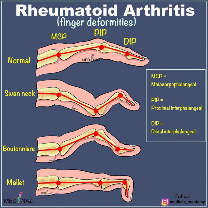 Finger deformities in Rheumatoid arthritis
