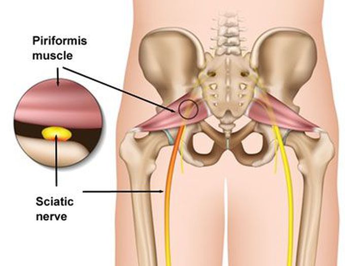 PIRIFORMIS SYNDROME