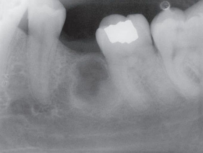 Ossifying fibroma