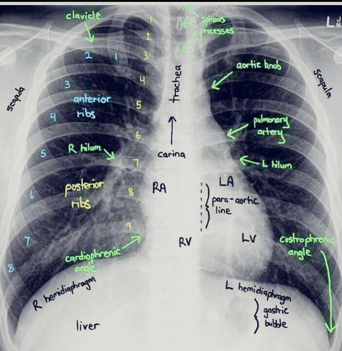 X-ray of thorax