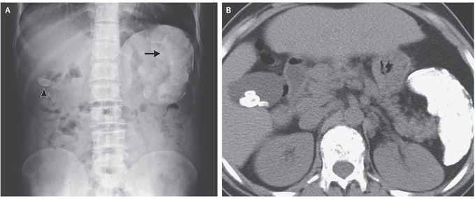 Calcified Spleen and Gallstones