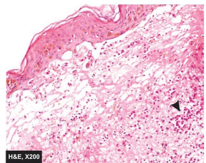 Dermatitis herpetiformis.